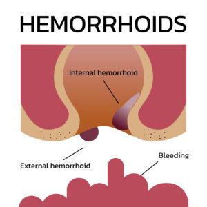 Internal and external hemorrhoids with bleeding infographic